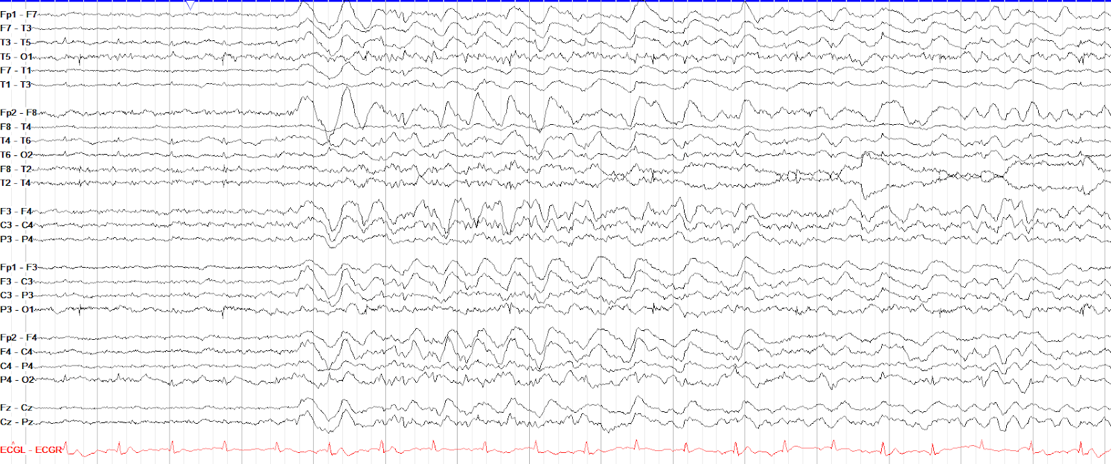 Slowing and other Non-Epileptiform Abnormalities